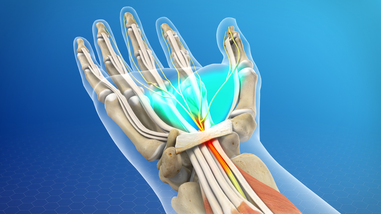 Carpal Tunnel Syndrome is a common condition that causes pain, numbness, an...